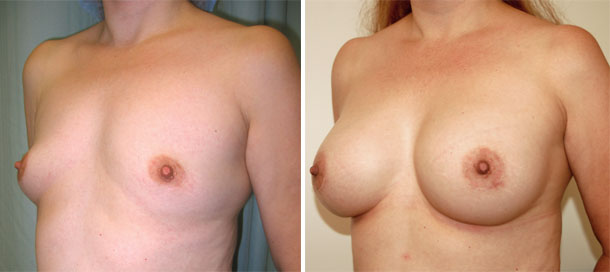 Breast Augmentation Testimonials