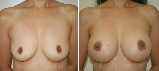 Breast Implants Results