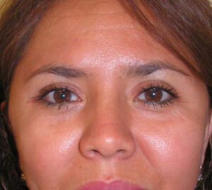 after blepharoplasty front view of female patient 2900
