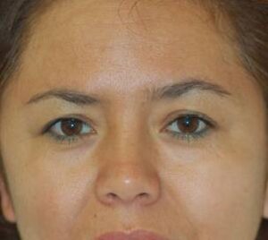 before blepharoplasty front view of female patient 2900