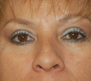 after blepharoplasty front view of female patient 2899