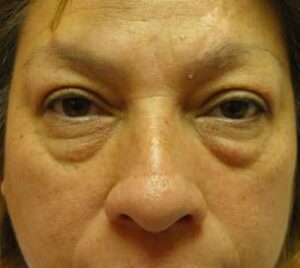 before blepharoplasty front view of female patient 2899