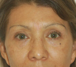 after blepharoplasty front view of female patient 2912