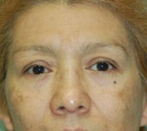 before blepharoplasty front view of female patient 2912