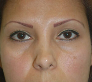 after blepharoplasty front view of female patient 2919