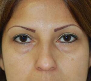 before blepharoplasty front view of female patient 2919