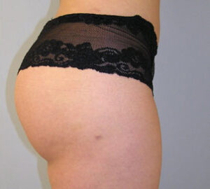 after Brazilian liposculpture right side view of female patient 3396