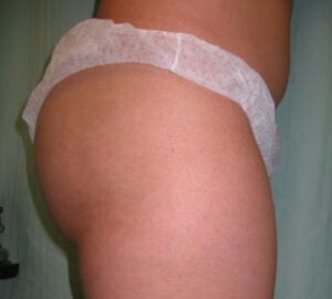 before Brazilian liposculpture right side view of female patient 3396