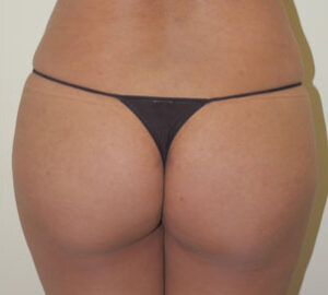 after Brazilian liposculpture rear view of female patient 3425