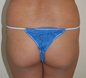 before Brazilian liposculpture rear view of female patient 3425