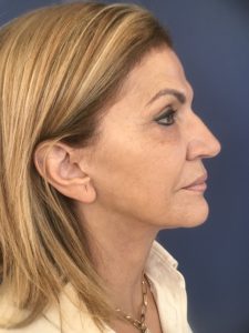after facelift right side view of female patient 2430