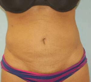 after liposuction front view of female patient 3232