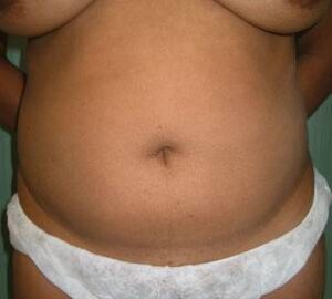 before liposuction front view of female patient 3232