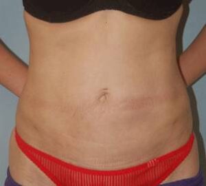 after liposuction front view of female patient 3246