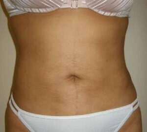 after tummy tuck front view of female patient 3289