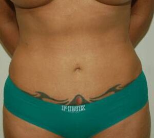 after liposuction front view of female patient 3336