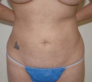 before liposuction front view of female patient 3351