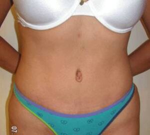 after Brazilian liposculpture front view of female patient 3365