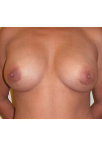 after mommy makeover upper front view of female patient 4184