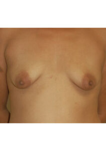 before mommy makeover upper front view of female patient 4184