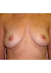 before mommy makeover upper front view of female patient 4197