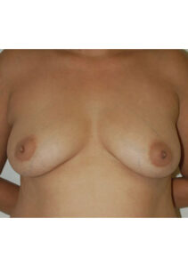 before mommy makeover upper front view of female patient 4210
