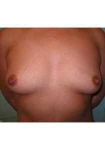before mommy makeover upper front view of female patient 4223