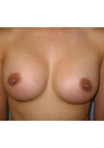 after mommy makeover upper front view of female patient 4236