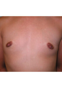 before mommy makeover upper front view of female patient 4236