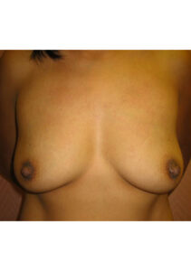 before mommy makeover upper front view of female patient 4250