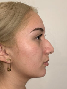 before rhinoplasty right side view of female patient 2599