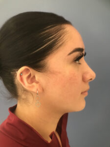 after rhinoplasty right side view of female patient 2599