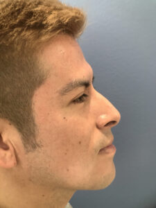 before rhinoplasty right side view of male patient 2619