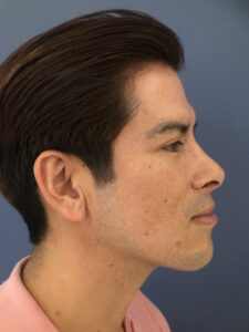 after rhinoplasty right side view of male patient 2619