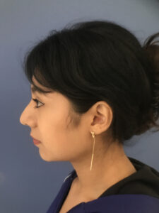 before rhinoplasty left side view of female patient 2700