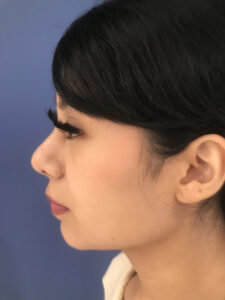 after rhinoplasty left side view of female patient 2700