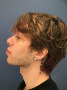 after rhinoplasty left side view of male patient 2706