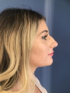 before rhinoplasty right side view of female patient 2714