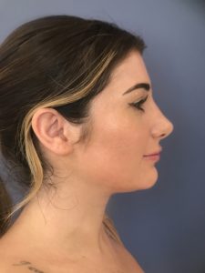 after rhinoplasty right side view of female patient 2714