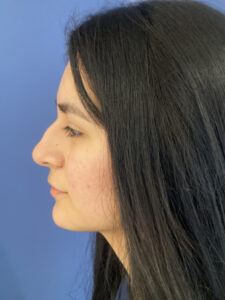 before rhinoplasty left side view of female patient 2747