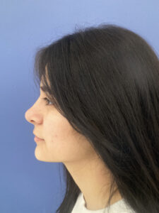 after rhinoplasty left side view of female patient 2747