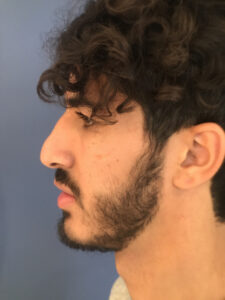 before rhinoplasty left side view of male patient 2754