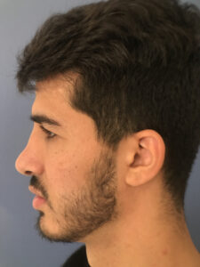 after rhinoplasty left side view of female patient 2754