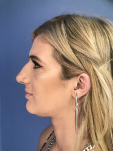 before rhinoplasty left side view of female patient 2761