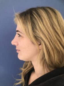 after rhinoplasty left side view of female patient 2761