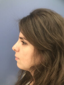 after rhinoplasty left side view of female patient 2768