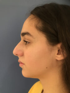 before rhinoplasty left side view of female patient 2808