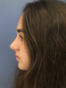 after rhinoplasty left side view of female patient 2808
