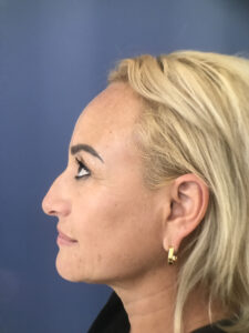 before rhinoplasty left side view of female patient 2818