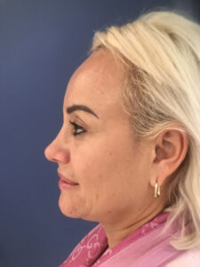 after rhinoplasty left side view of female patient 2818